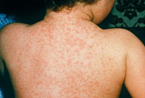 イタリアで麻疹（麻しん）大流行 在イタリア大使館からの注意喚起